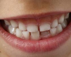 Kłopoty z wyżynaniem się zębów