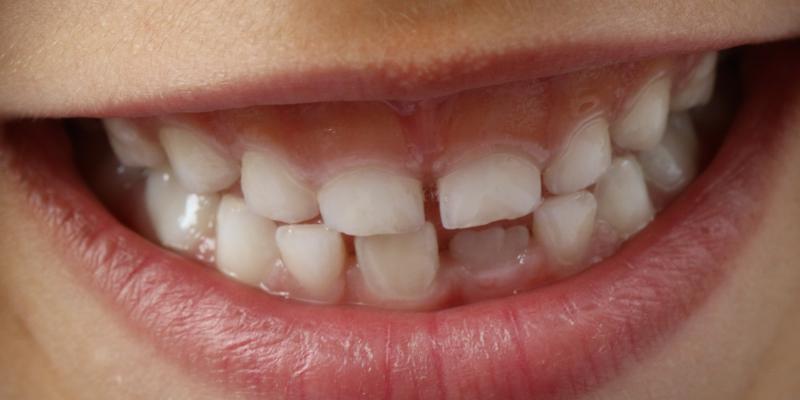Kłopoty z wyżynaniem się zębów
